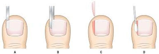 Ingrown toenail surgery